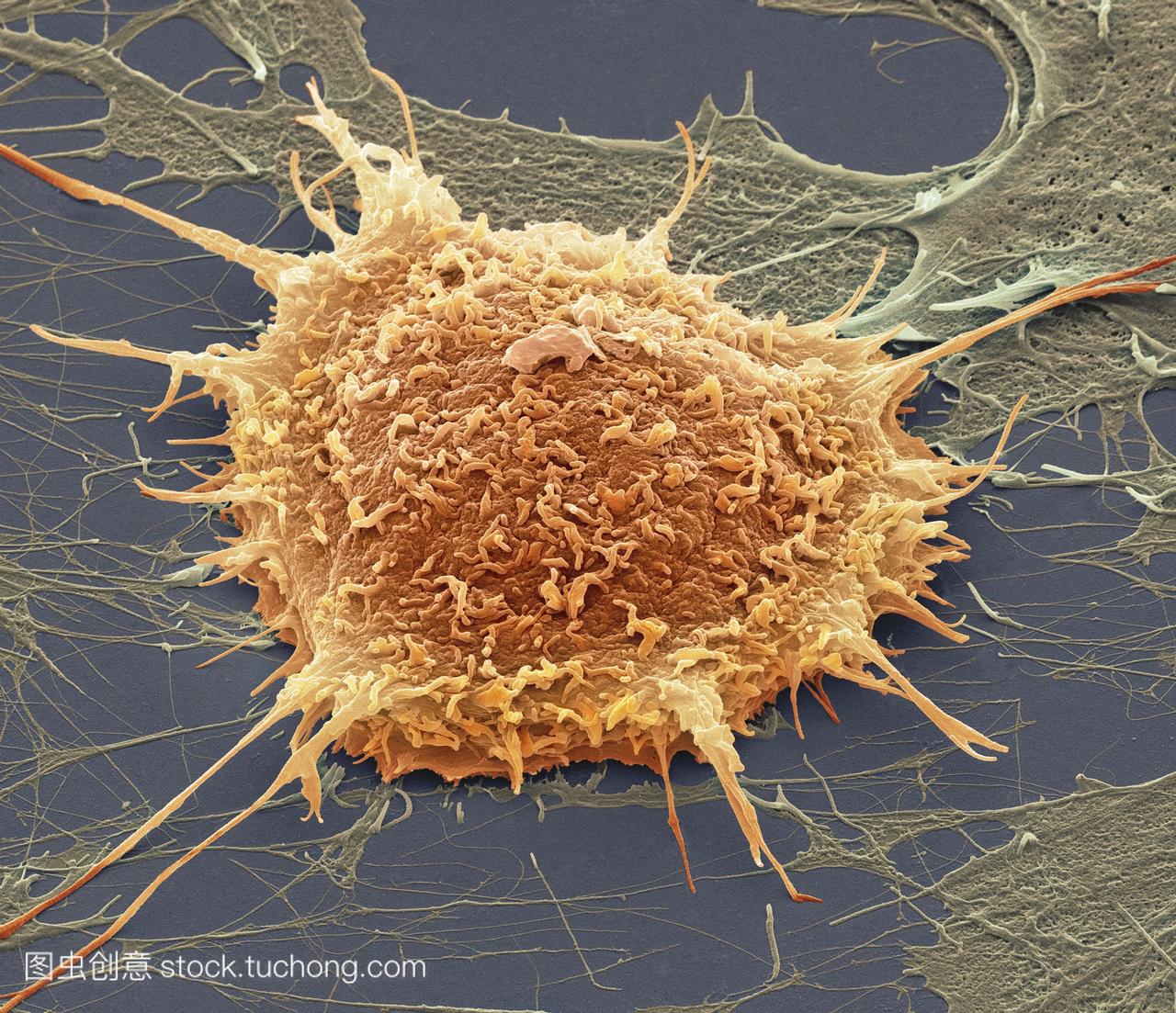 宫颈癌细胞,彩色扫描电镜sem。培养的癌细胞