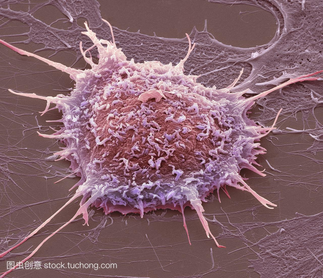 宫颈癌细胞,彩色扫描电镜sem。培养的癌细胞