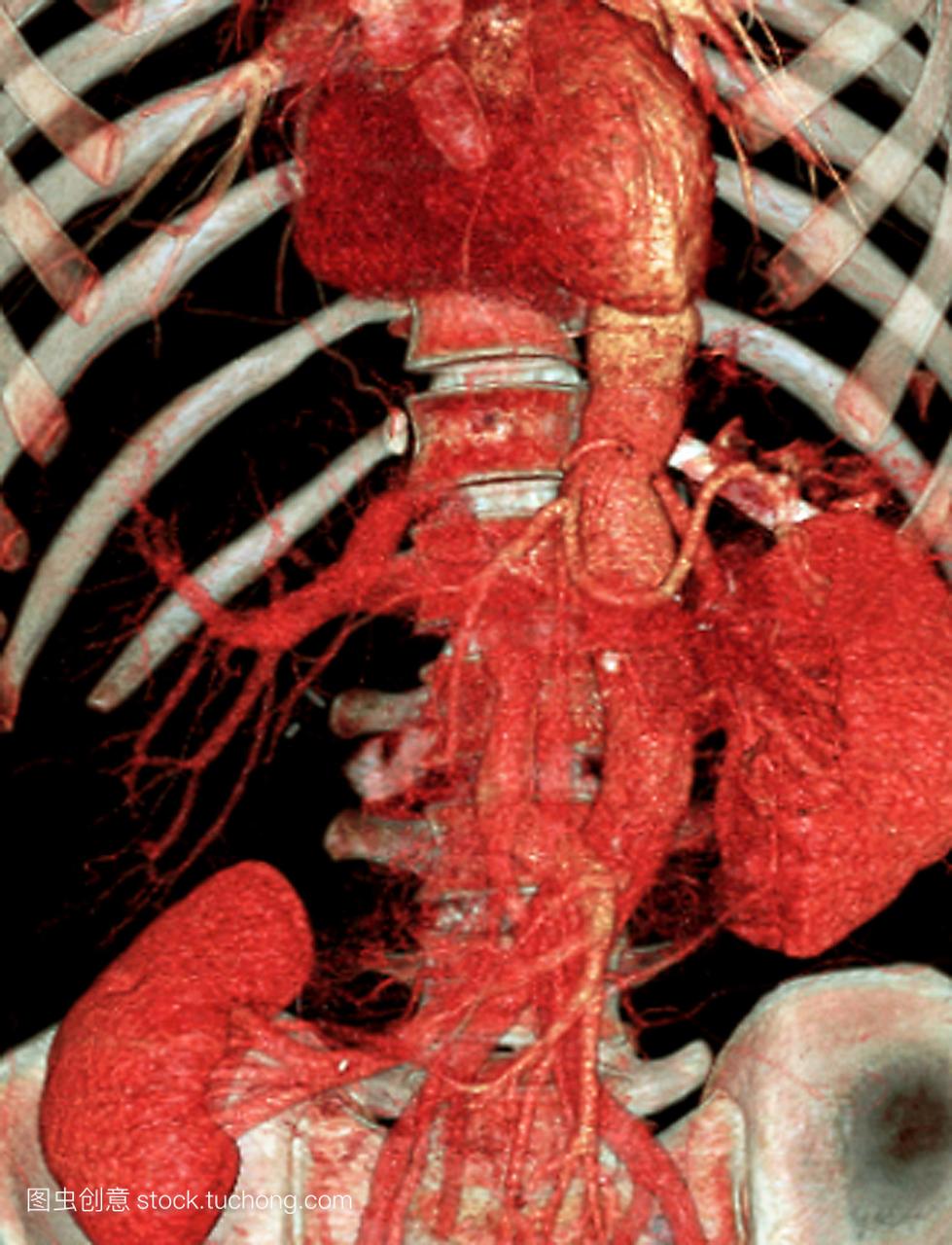 3d3d计算机断层扫描ct在30岁的患者腹腔内的