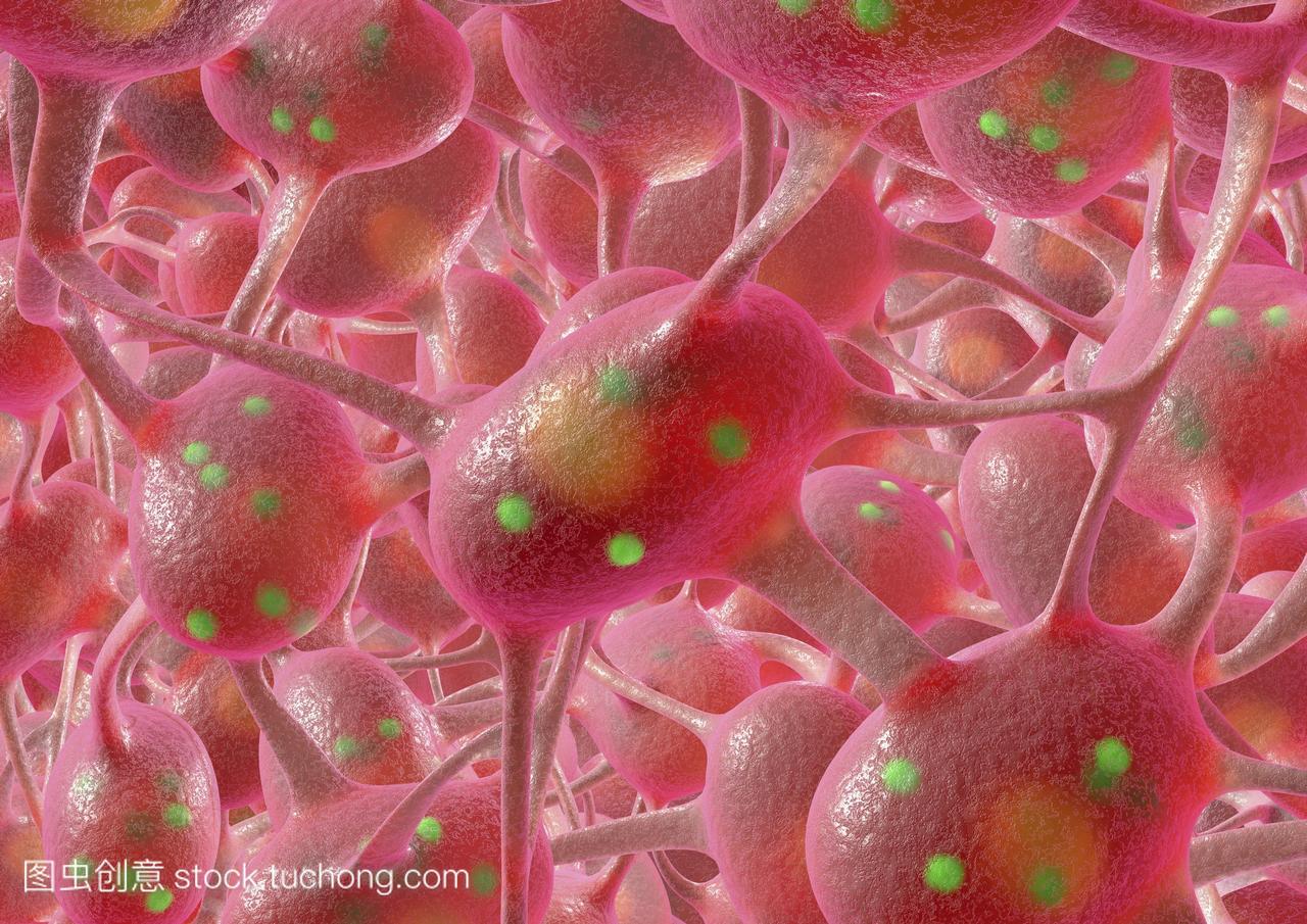 帕金森病的电脑绘图神经元神经细胞粉红色包含