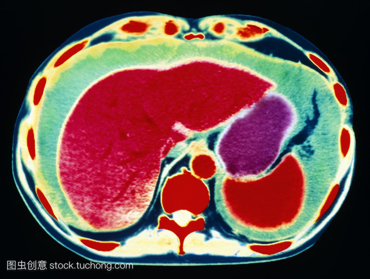 腹水。彩色的计算机断层扫描CT扫描轴向截面