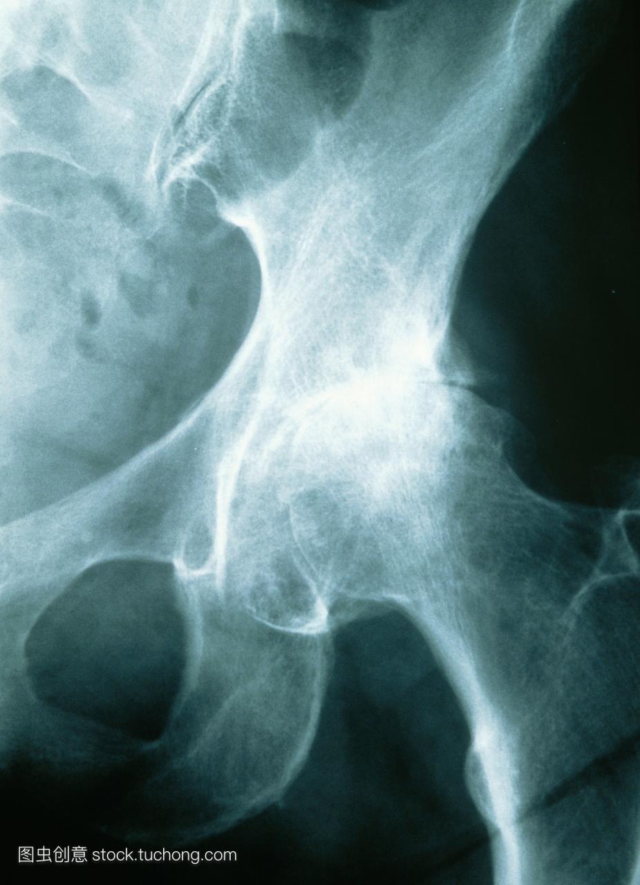 x射线的髋关节骨关节炎的一位67岁的女人。在