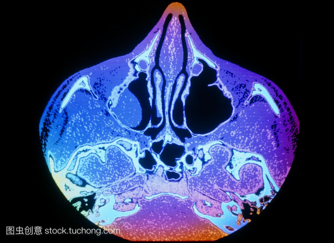息肉。彩色计算机断层扫描ct扫描显示在上颌骨