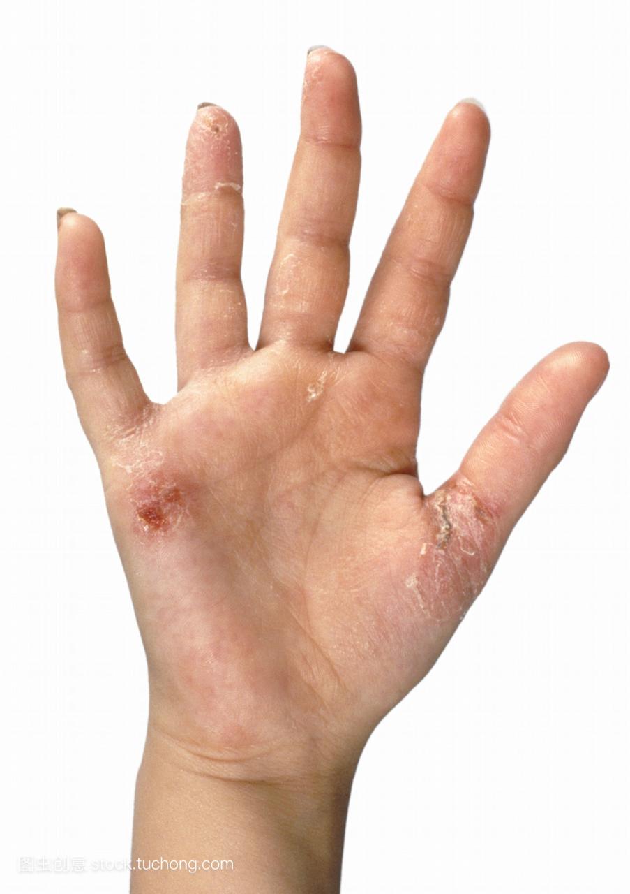 性皮炎的手受到接触性皮炎的一百一十岁的小女