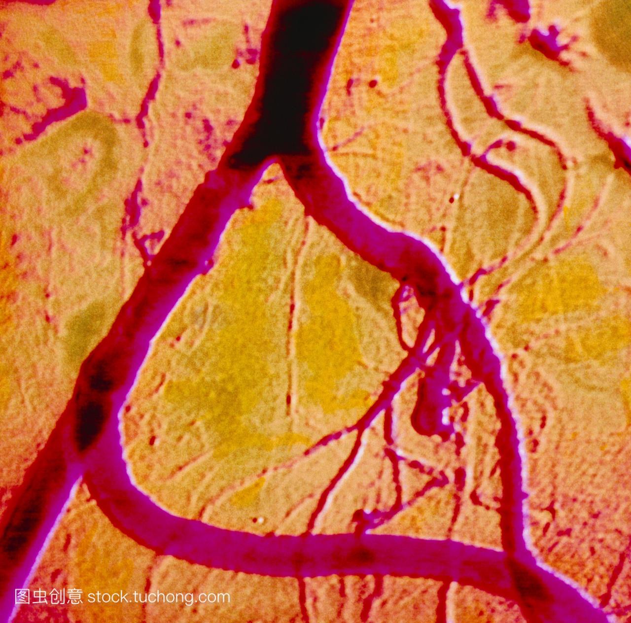 髂动脉旁路的彩色血管造影动脉旁路较低的帧s