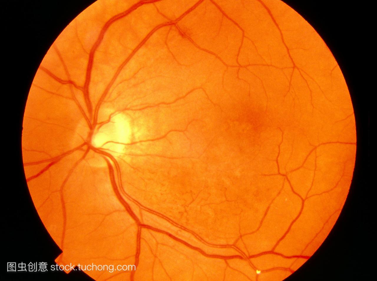 视网膜闭塞的堵塞是一个或多个视网膜血管。堵