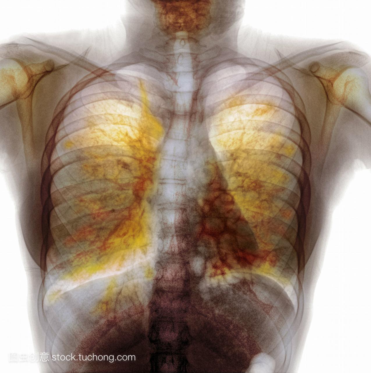 视图显示肺中有粘液的15岁女性囊性纤维化cf。