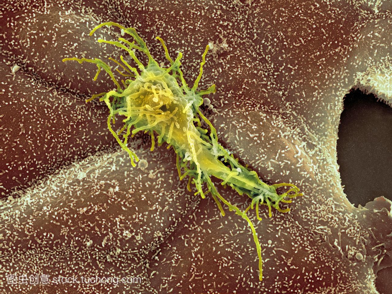 微镜sem的癌细胞黄色在正常的上皮细胞棕色的