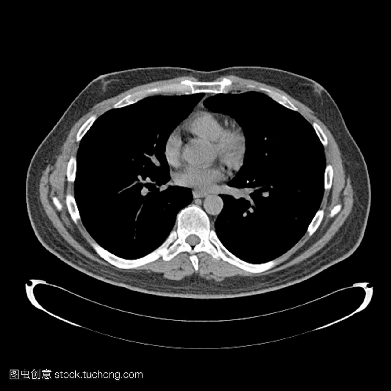 x射线计算机断层扫描ct成人男性胸部横截面